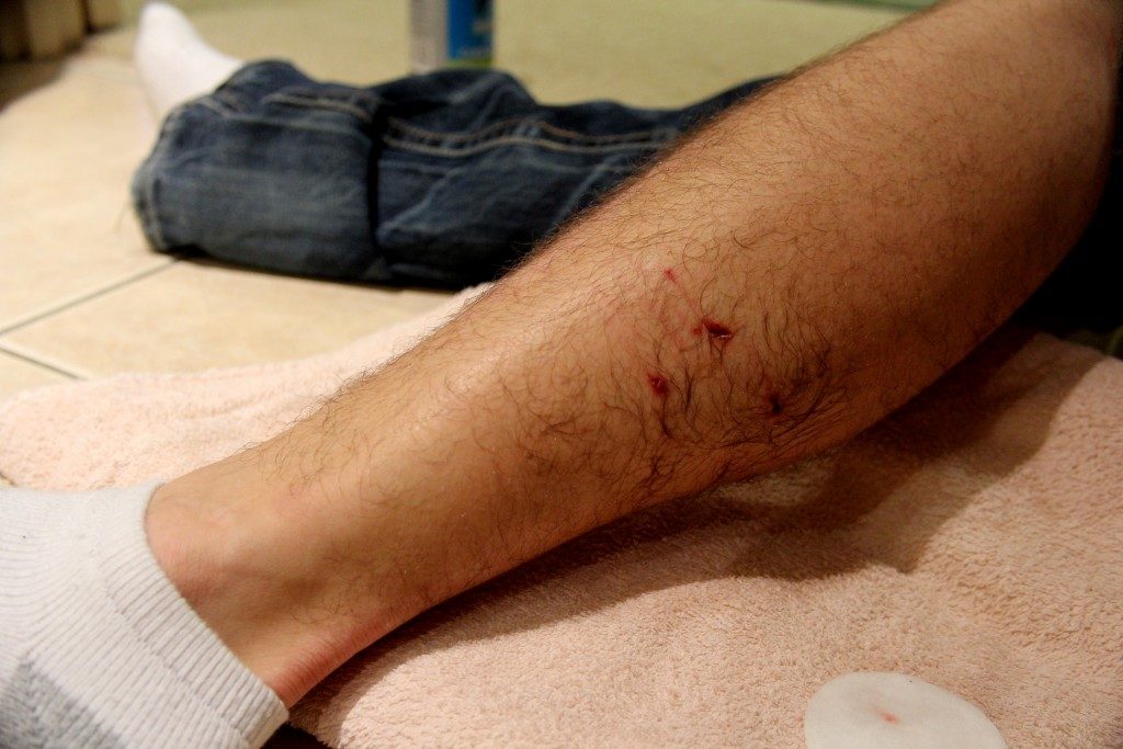 Man with wound on leg